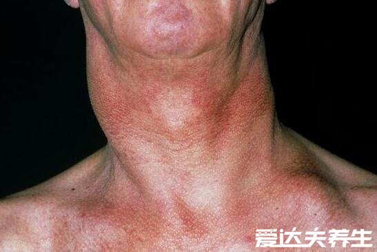 脖子淋巴癌早期图片，颈部有明显肿块且无痛感可能是患上了癌症