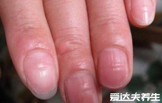 指甲竖纹多是癌症没有科学依据，多为营养缺失导致