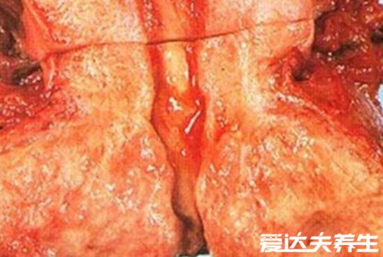 宫颈癌早期三处痒，阴道/外阴/面部(附早期宫颈癌分泌物图片)