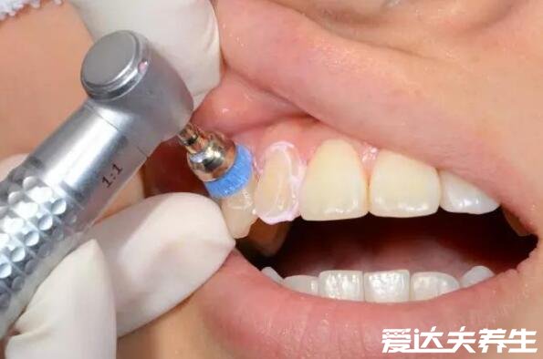 为什么医生不推荐洗牙，部分病症不适合洗牙否则会加重病情