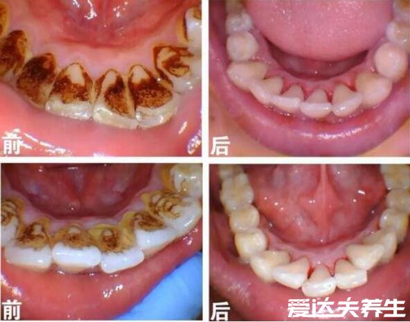 为什么医生不推荐洗牙，部分病症不适合洗牙否则会加重病情