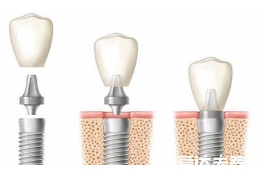 種植牙有什么風險和后遺癥，可能導致神經紊亂/牙齦萎縮