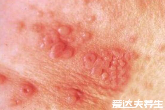 女人艾滋病的三大症状图片，宫颈有红色水泡要注意(附自查方法)