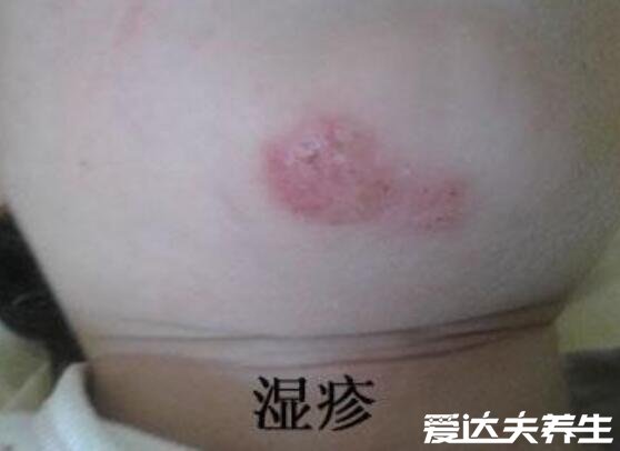 湿疹和热疹的区别图片，湿疹多发于面部呈红色肿块或鳞状皮疹