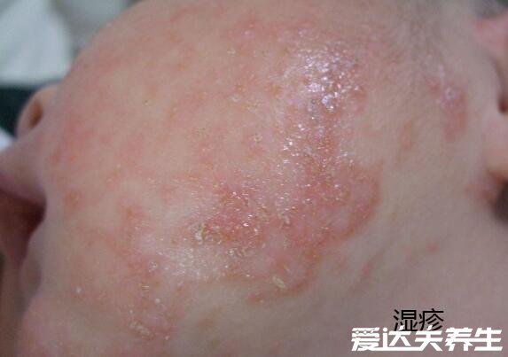 湿疹和热疹的区别图片，湿疹多发于面部呈红色肿块或鳞状皮疹