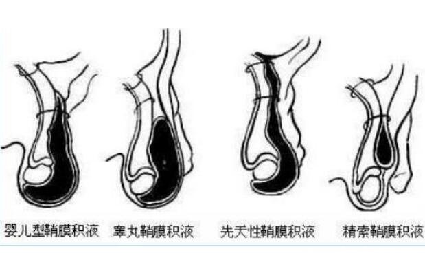 鞘膜积液真正图片，腹股沟/阴囊出现肿物要警惕(和疝气相似)
