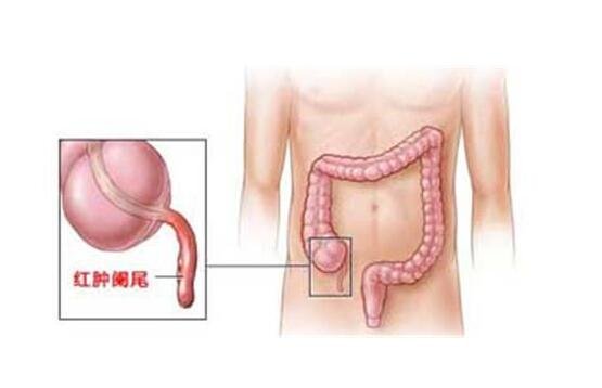 阑尾炎的疼痛位置图片，位于盲肠与回肠之间人体的右下腹处