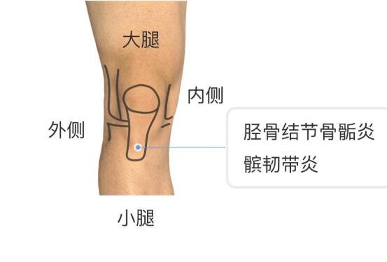 膝盖各个部位疼痛图解，膝盖两侧疼痛最严重须及时就医