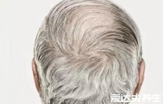 三个部位长白发最危险，两鬓/后脑勺/前额头有可能影响性生活