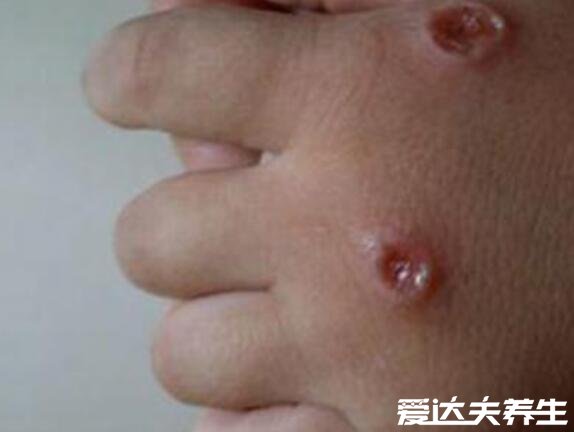 水痘的7天演变过程图片，护理方法得当一周就能痊愈不留疤痕