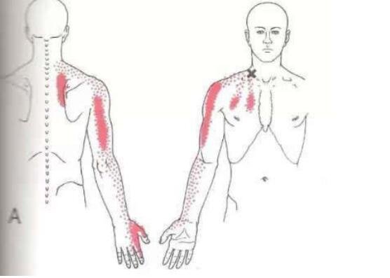 人体后背疼痛位置图详解，肩颈疼痛可能是患上了颈椎病