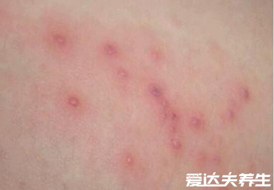 湿疹图片初期症状图片，有红斑状水泡瘙痒感强烈十分难受