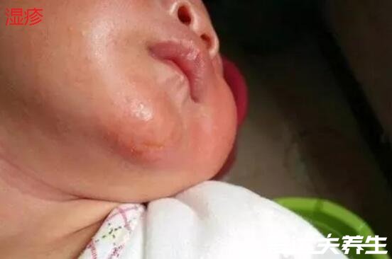 宝宝婴儿湿疹图片，多为密集针尖状小水泡痒感强烈