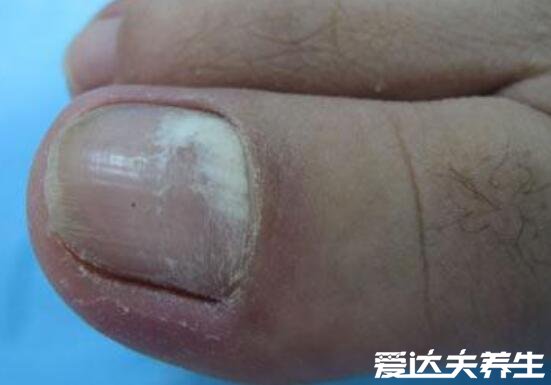最轻微的初早期灰指甲图片，出现这这两种症状需要及时治疗