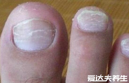 最轻微的初早期灰指甲图片，出现这这两种症状需要及时治疗