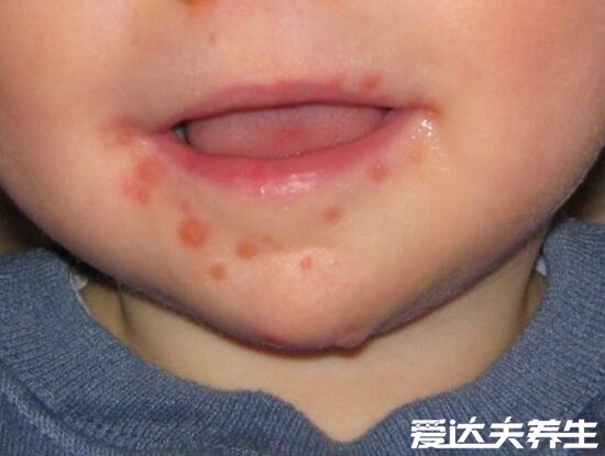 小儿手足口病最早期图片及症状，为红色丘疹伴随低烧(预防事项)