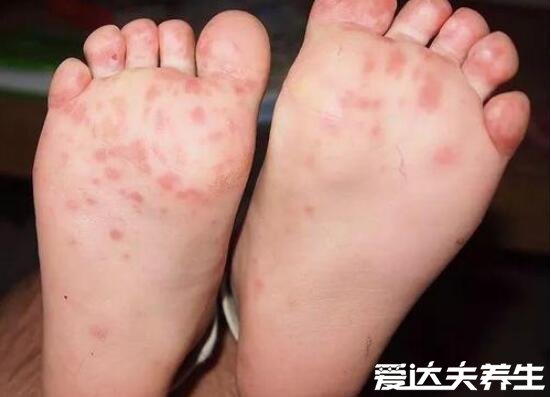 小儿手足口病最早期图片及症状，为红色丘疹伴随低烧(预防事项)