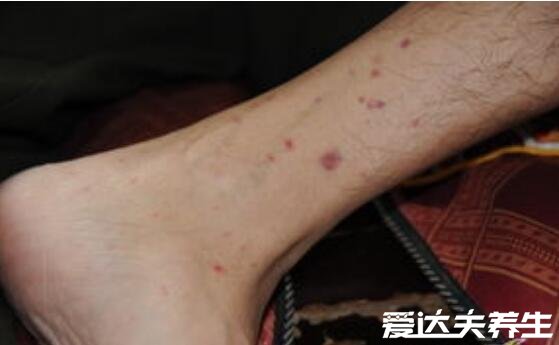 白血病初期小血点图片及症状，为皮肤瘀斑多伴随发烧/贫血