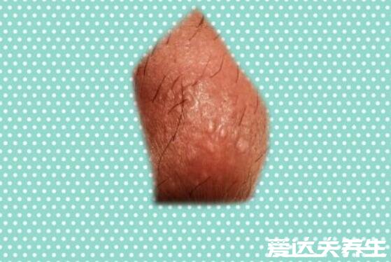男女初期小疣体图片，有明显红色菜花样小疙瘩易成片出现