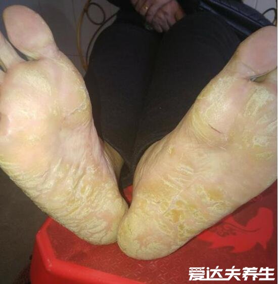 4种不同类型脚气的图片，脚部水疱或溃烂都可能是脚气引起的