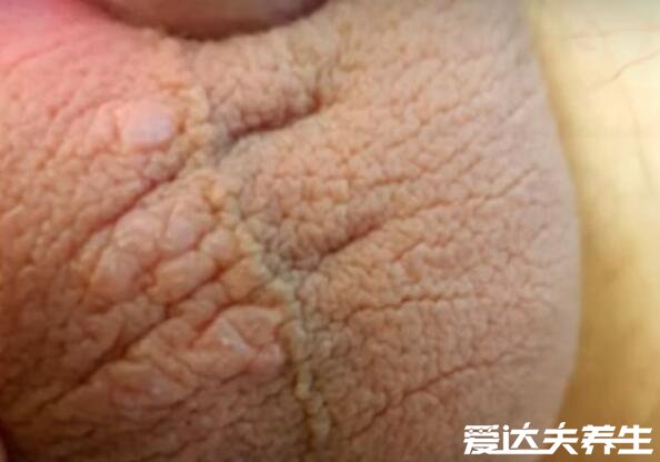 3种类型的阴囊湿疹图片，阴囊发红肿胀伴随瘙痒要小心