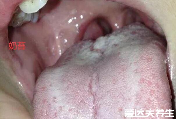 婴儿鹅口疮最早期图片，口腔内有白色的乳状物和奶苔很像