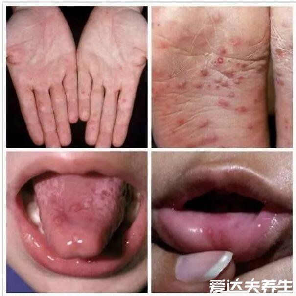 手足口病症状初期图片，出现感冒症状伴随红色丘疹和疱疹时要注意