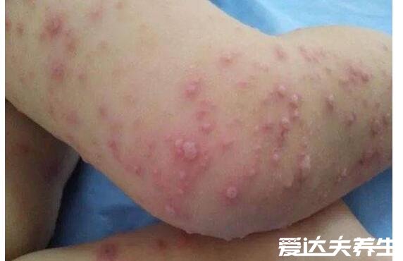 手足口病症状初期图片，出现感冒症状伴随红色丘疹和疱疹时要注意