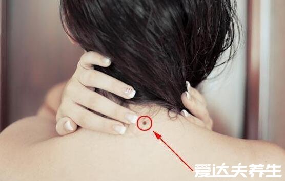 脖子上有痣代表什么，不仅有可能为桃花劫还有可能是癌症
