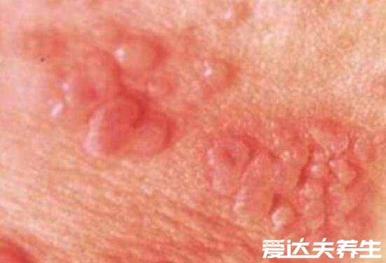 女性疣病是什么症状图片，出现红色丘疹且伴随瘙痒异味
