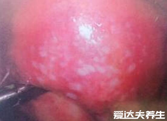 女性疣病是什么症状图片，出现红色丘疹且伴随瘙痒异味