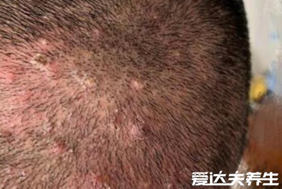 毛囊炎的图片症状及治疗方法，为红色毛囊性丘疹如米粒大小