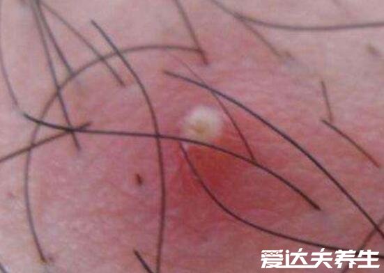 毛囊炎的图片症状及治疗方法，为红色毛囊性丘疹如米粒大小