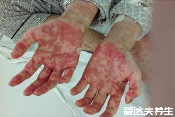 白血病初期小红点图片，警惕突出表皮的小红点有丘疹结节