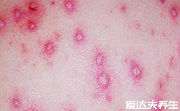 水痘刚开始的样子图片，从红点很快变成水泡(10天左右可自愈)