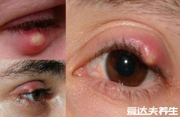 麦粒肿早期图片，眼睛长针眼的早期症状