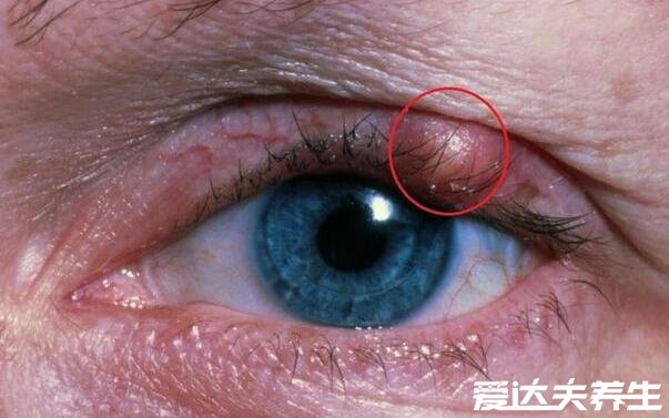 麦粒肿早期图片，眼睛长针眼的早期症状