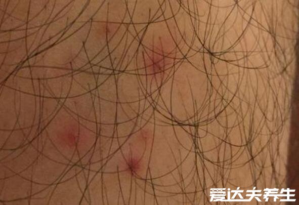 毛囊炎图片和初期症状，瘙痒疼痛的红色丘疹会发展成脓包