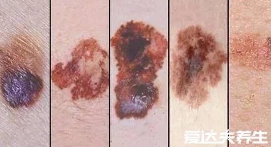 黑色素瘤早期症状图片，和普通黑痣相似但又有五点不同