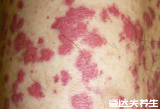 紫癜初期的图片及症状，会出现对称性斑疹且反复发作