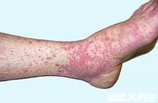 紫癜初期的图片及症状，会出现对称性斑疹且反复发作