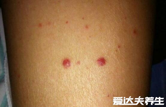 艾滋皮肤初期症状图片，多为略微凸起的红点且反复发作