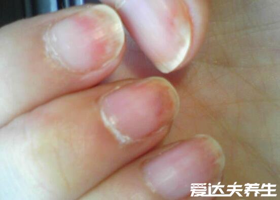 轻微灰指甲图片症状及治疗方法，为指甲轻微发黄且逐渐变厚