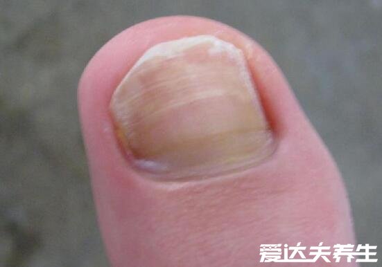 轻微灰指甲图片症状及治疗方法，为指甲轻微发黄且逐渐变厚