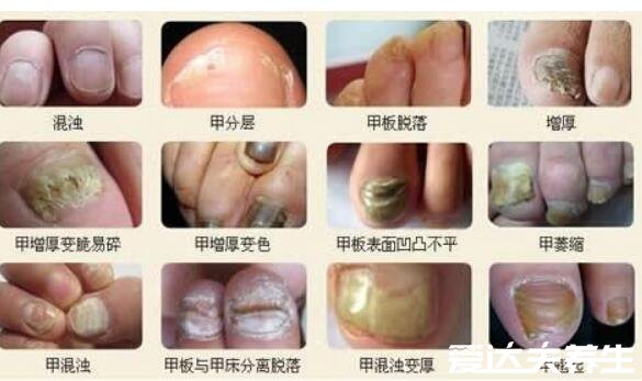 灰指甲初期症状图片及治疗方法，有两大症状需及时治疗(慎入)