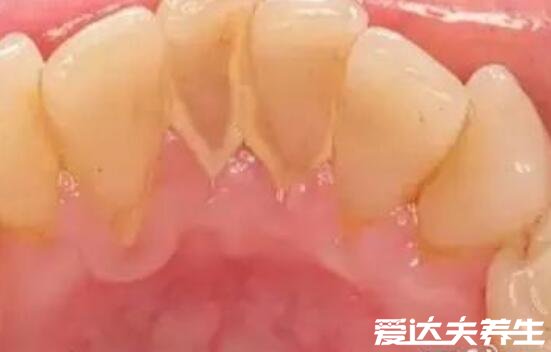 牙结石图片及症状是什么样，牙龈附近有黄色或褐色物质造成口臭