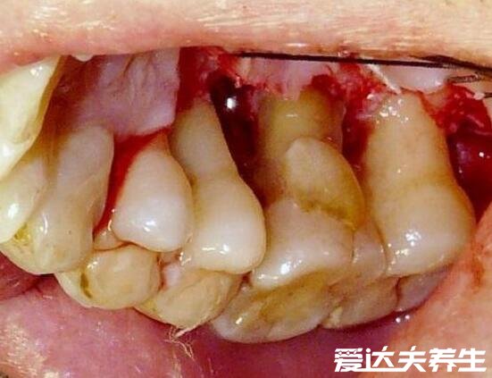 牙周炎图片症状及会传染吗，多表现牙龈红肿有脓血但不会传染