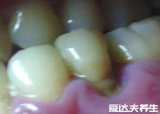 牙周炎图片症状及会传染吗，多表现牙龈红肿有脓血但不会传染