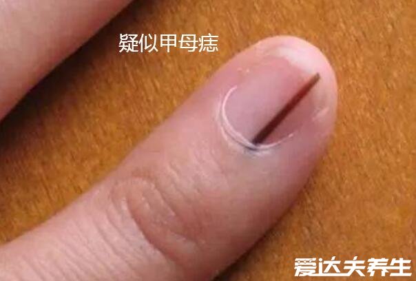 指甲黑色素瘤图片，指甲出现黑线和甲母痣很像要警惕恶化