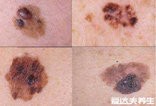 指甲黑色素瘤图片，指甲出现黑线和甲母痣很像要警惕恶化